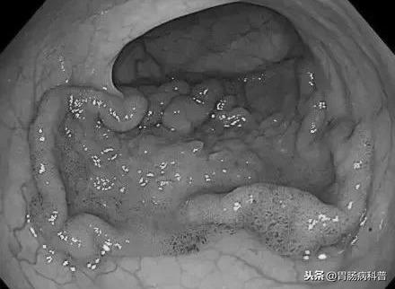 肠息肉会癌变，为什么会长肠息肉？有没有办法预防？