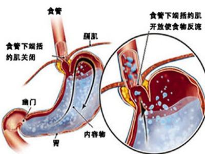 胃食管反流的症状多变？怎么判断胃食管反流？医生：看对科室很关键