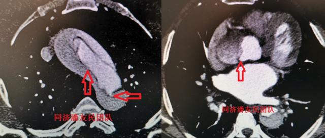 心梗、主动脉夹层傻傻分不清？3个病例帮你搞定