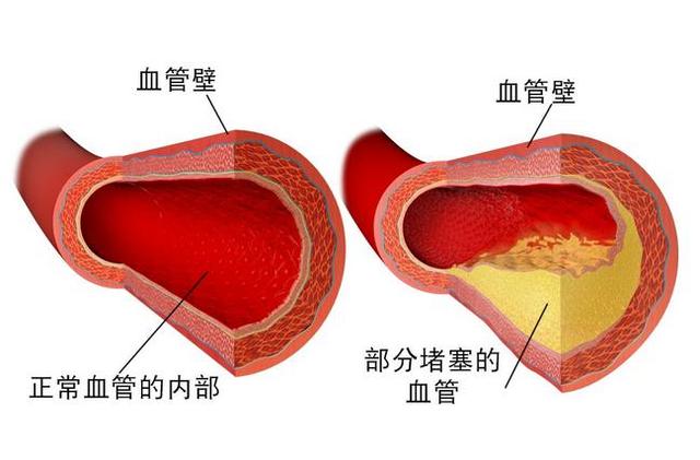 低密度脂蛋白升高，可能还没有引起你的重视
