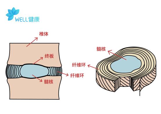 18岁就腰突了，腰突症会随着年龄增加而加剧吗？