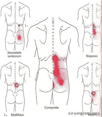 腰椎周边的肌肉筋膜劳损，会形成痛点导致腰痛，有办法令其消失吗