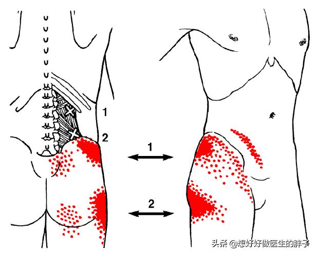 腰椎周边的肌肉筋膜劳损，会形成痛点导致腰痛，有办法令其消失吗