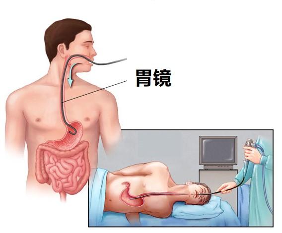 预防“胃癌”，这些您值得了解