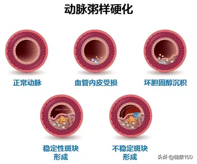 血管里有垃圾毒素要排？保护血管，这6招比吃保健品管用！