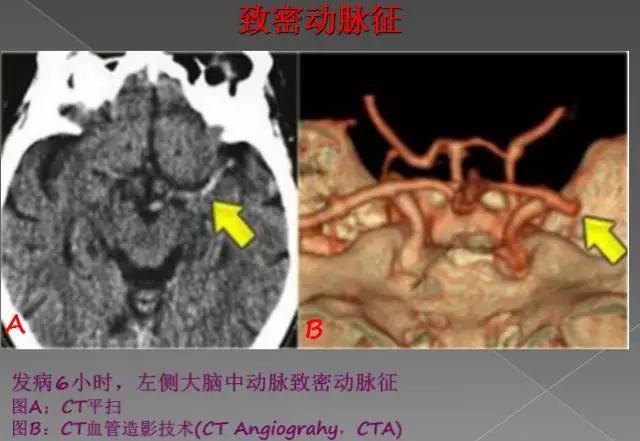 缺血性、出血性、分水岭、腔隙性四大类脑梗的影像区别