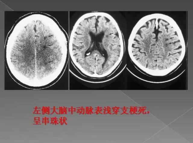 缺血性、出血性、分水岭、腔隙性四大类脑梗的影像区别