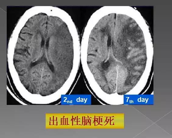 缺血性、出血性、分水岭、腔隙性四大类脑梗的影像区别