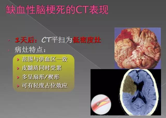 缺血性、出血性、分水岭、腔隙性四大类脑梗的影像区别