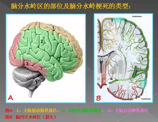 缺血性、出血性、分水岭、腔隙性四大类脑梗的影像区别