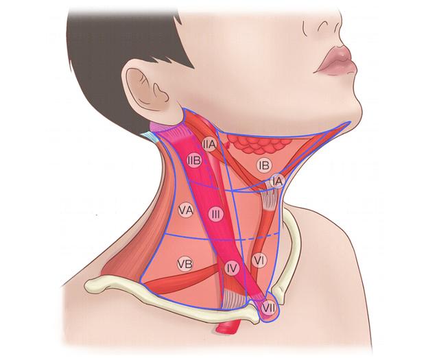 甲状腺患者什么情况要做颈部淋巴结清扫术？颈部淋巴结清扫怎么做