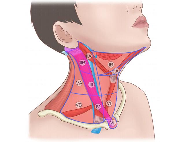 甲状腺患者什么情况要做颈部淋巴结清扫术？颈部淋巴结清扫怎么做