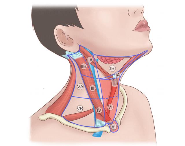 甲状腺患者什么情况要做颈部淋巴结清扫术？颈部淋巴结清扫怎么做