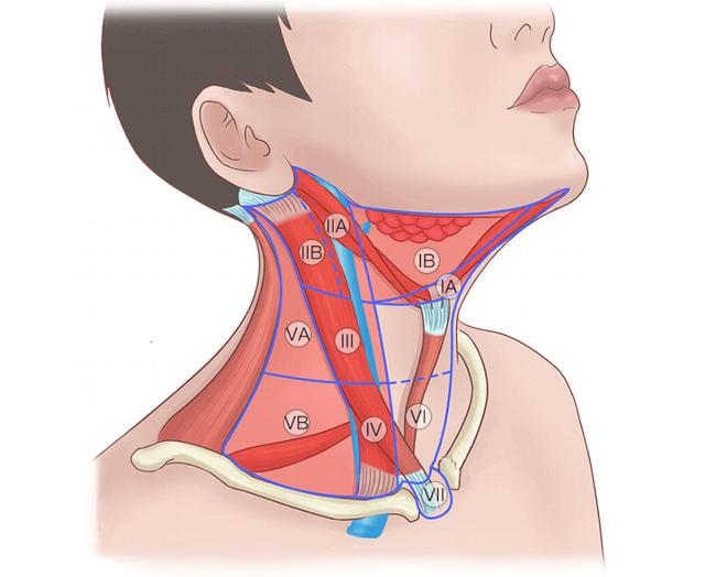 甲状腺患者什么情况要做颈部淋巴结清扫术？颈部淋巴结清扫怎么做