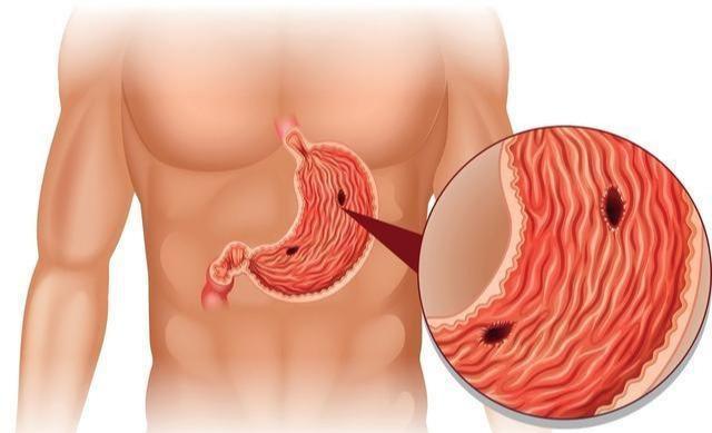 吃饭时的4种迹象，说明胃溃疡无疑，日常养胃做好3事
