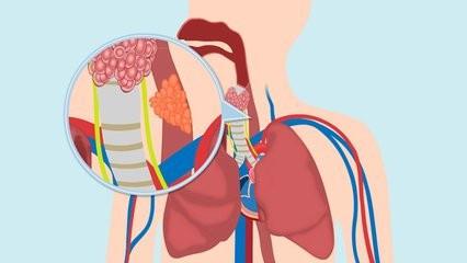 日常如何饮食预防食道癌?食道癌早期有这5大信号