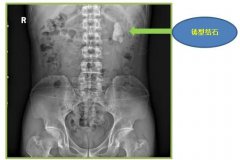 鸡蛋大的肾结石，要拿肾“开刀”吗？