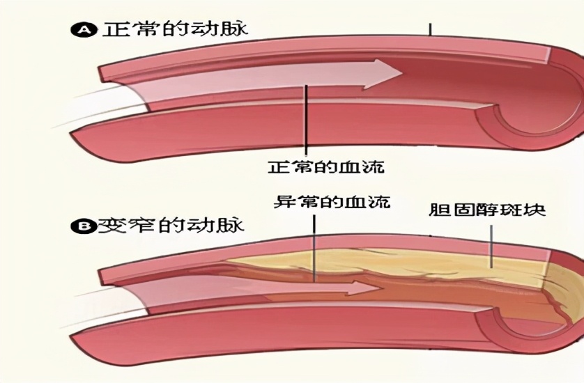 胆固醇正不正常？化验单说得还不算，什么原因？医生为您讲清楚