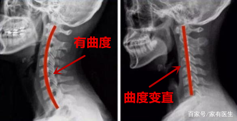 被颈椎病困扰的上班族，缓解颈椎不适，从改变自己的习惯开始