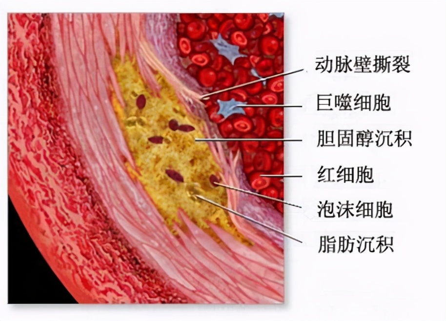 颈动脉斑块不能跑步，否则有破裂引发脑梗的风险！医生辟谣讲清楚