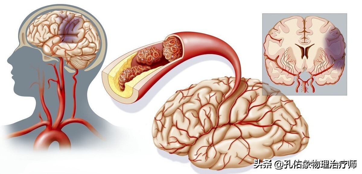 为何如此多的人发生脑梗？要怎么正确应对？一文给您详细讲清楚