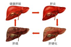 乙肝人群出现一臭二红三黄，提示你该