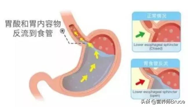 胃胀、胃反酸、胃溃疡，可以吃什么食物缓解胃酸过多？