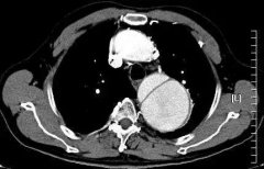 主动脉夹层患者：医生，如果检查正常